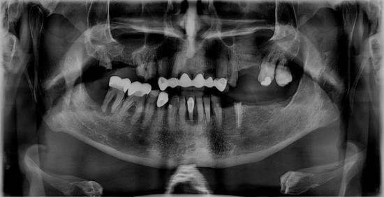 a panoramic x-ray of a person 's teeth and skull .