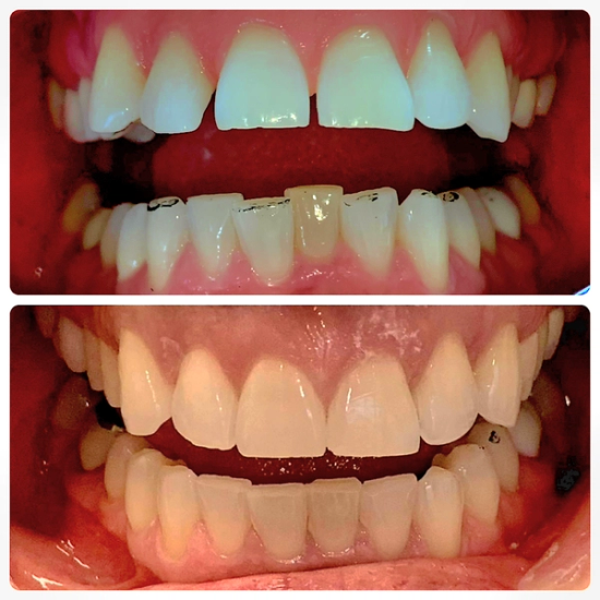 a before and after photo of a person 's teeth