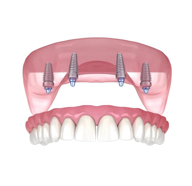 a 3d rendering of a full denture with four dental implants .
