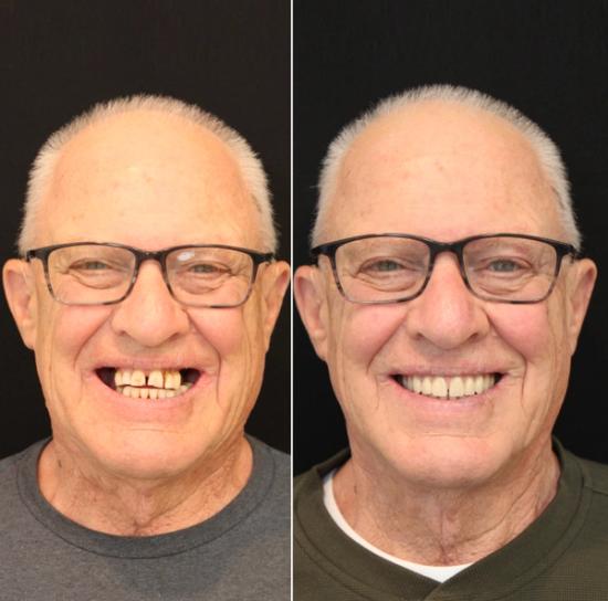 a before and after photo of a man with glasses and missing teeth .