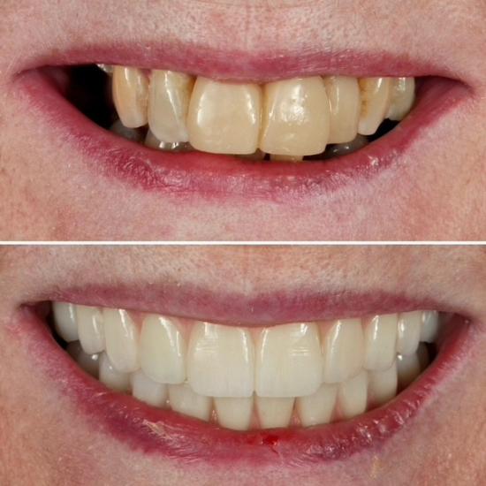 a before and after picture of a woman 's teeth .
