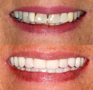 a before and after picture of a woman 's teeth .