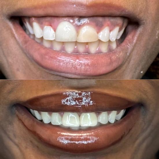 Before and after close-up of a smile, showing a transformation from discolored, uneven teeth to uniformly white, straight teeth.