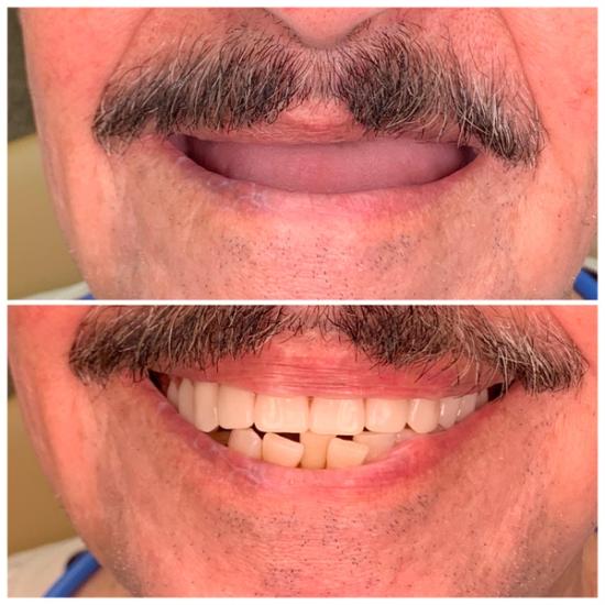 a man with a mustache has a before and after picture of his teeth .