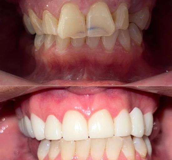 a before and after picture of a person 's teeth .