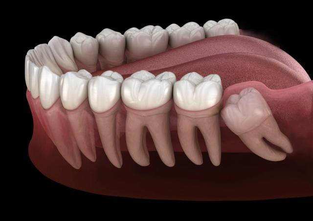 a computer generated image of a person 's teeth showing a wisdom tooth .