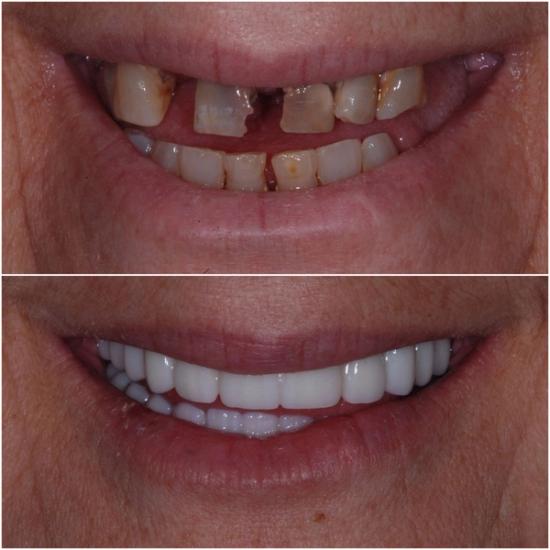 Before and after close-up of a person's mouth: top shows damaged, discolored, and missing teeth, bottom shows a full set of bright, white, even teeth.
