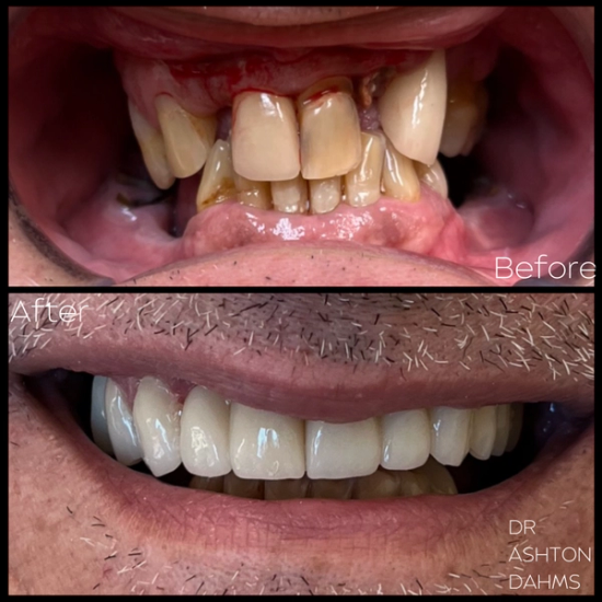 a before and after photo of a man 's teeth by dr ashton dahms