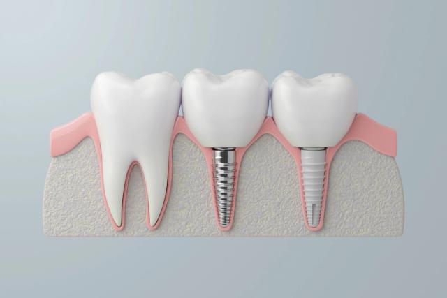 a 3d rendering of a row of teeth with dental implants .