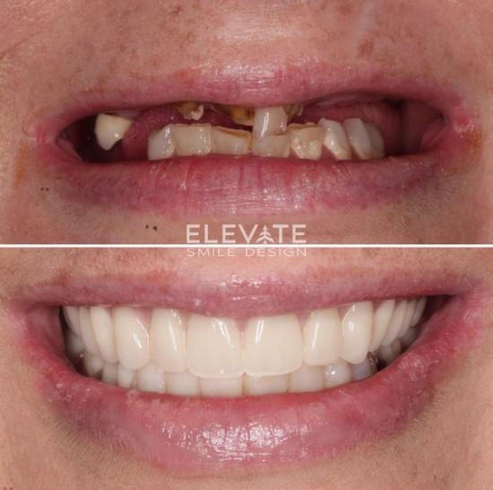 a before and after photo of a woman 's teeth .