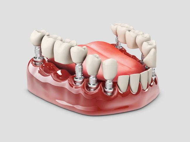 a 3d rendering of a full denture with dental implants .