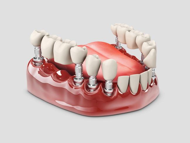 a 3d rendering of a full denture with dental implants .
