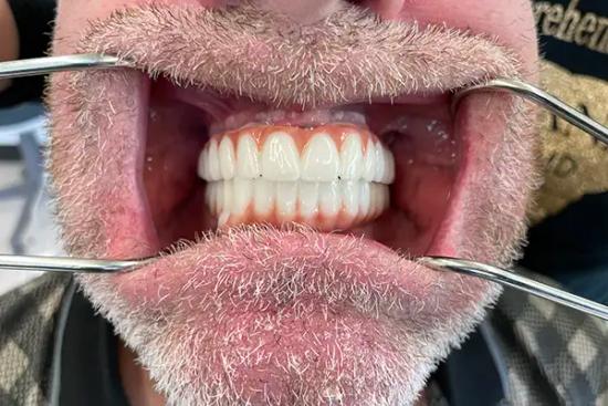 a man with a beard and dentures in his mouth .