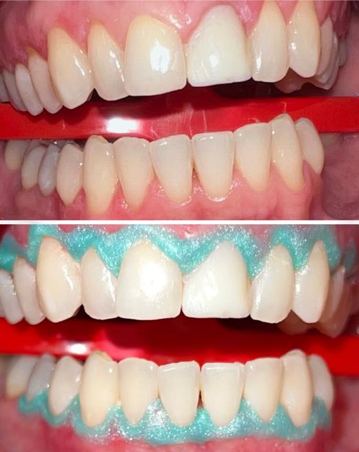 a before and after picture of a person 's teeth