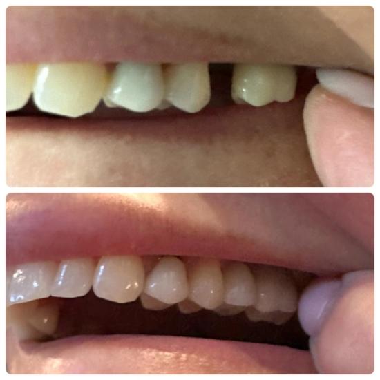 a before and after picture of a person 's teeth