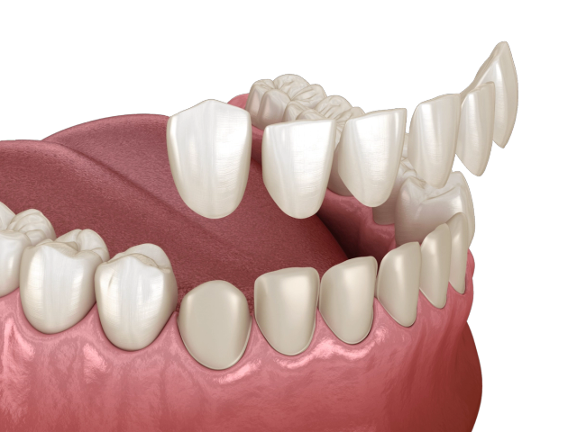 a computer generated image of a person 's teeth showing a dental bridge