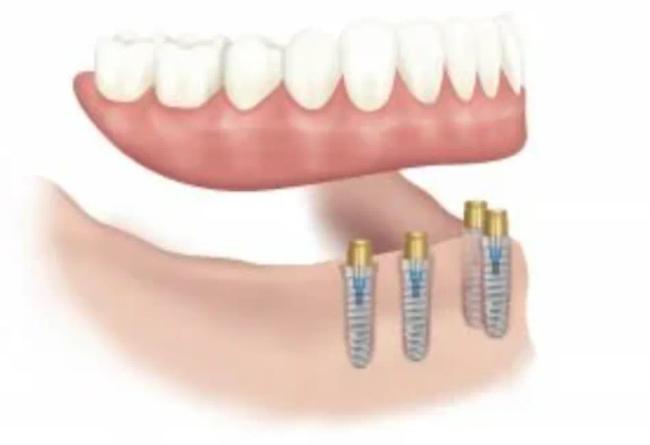 a drawing of a person 's teeth with dental implants .