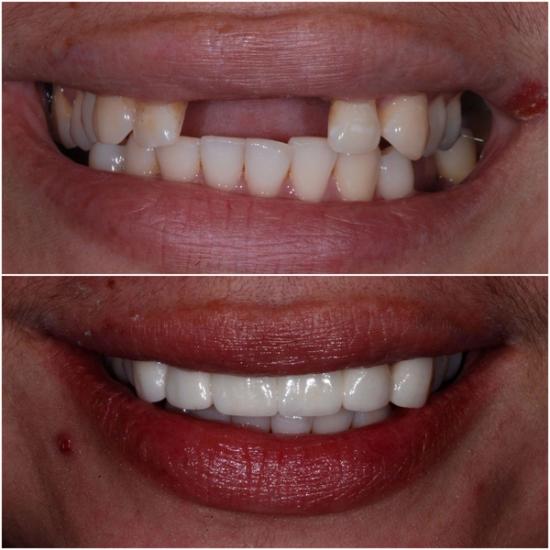 Before and after comparison of a smile: top shows missing and discolored teeth, bottom shows a full set of bright, even teeth.