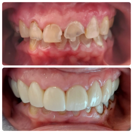 a before and after photo of a person 's teeth
