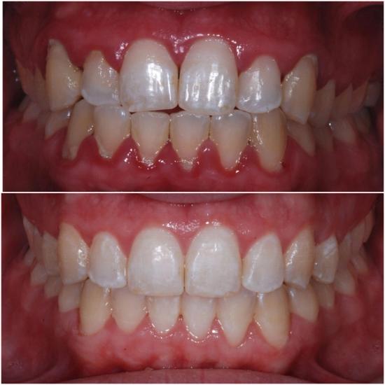 Before (top) and after (bottom) dental images showing straightened, whitened teeth and healthier gums with reduced recession.