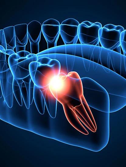 3D illustration of a translucent blue jaw and teeth, with one molar glowing red from pain.