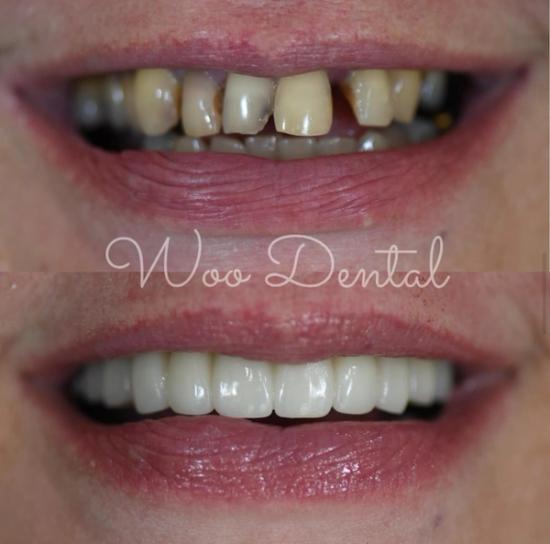 a before and after photo of a woman 's teeth .