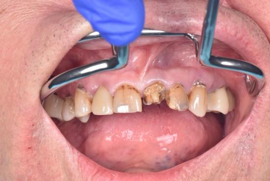 a close up of a person 's mouth with broken teeth .
