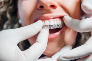 a woman is getting her teeth straightened by a dentist .