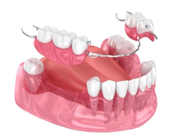 it is a 3d rendering of a partial denture .