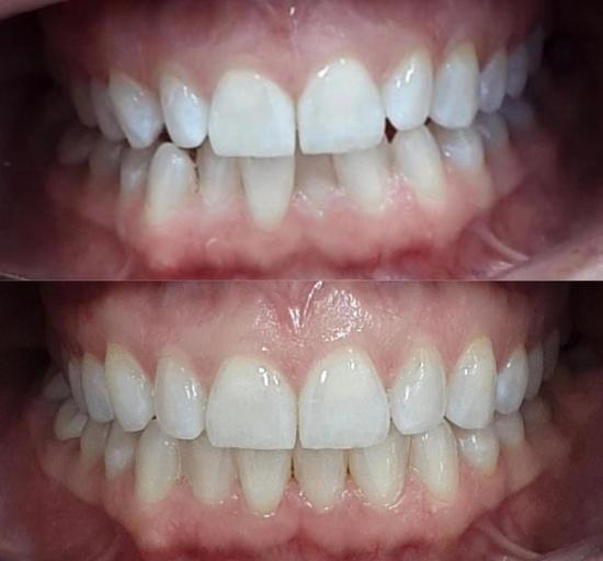 a before and after picture of a person 's teeth .