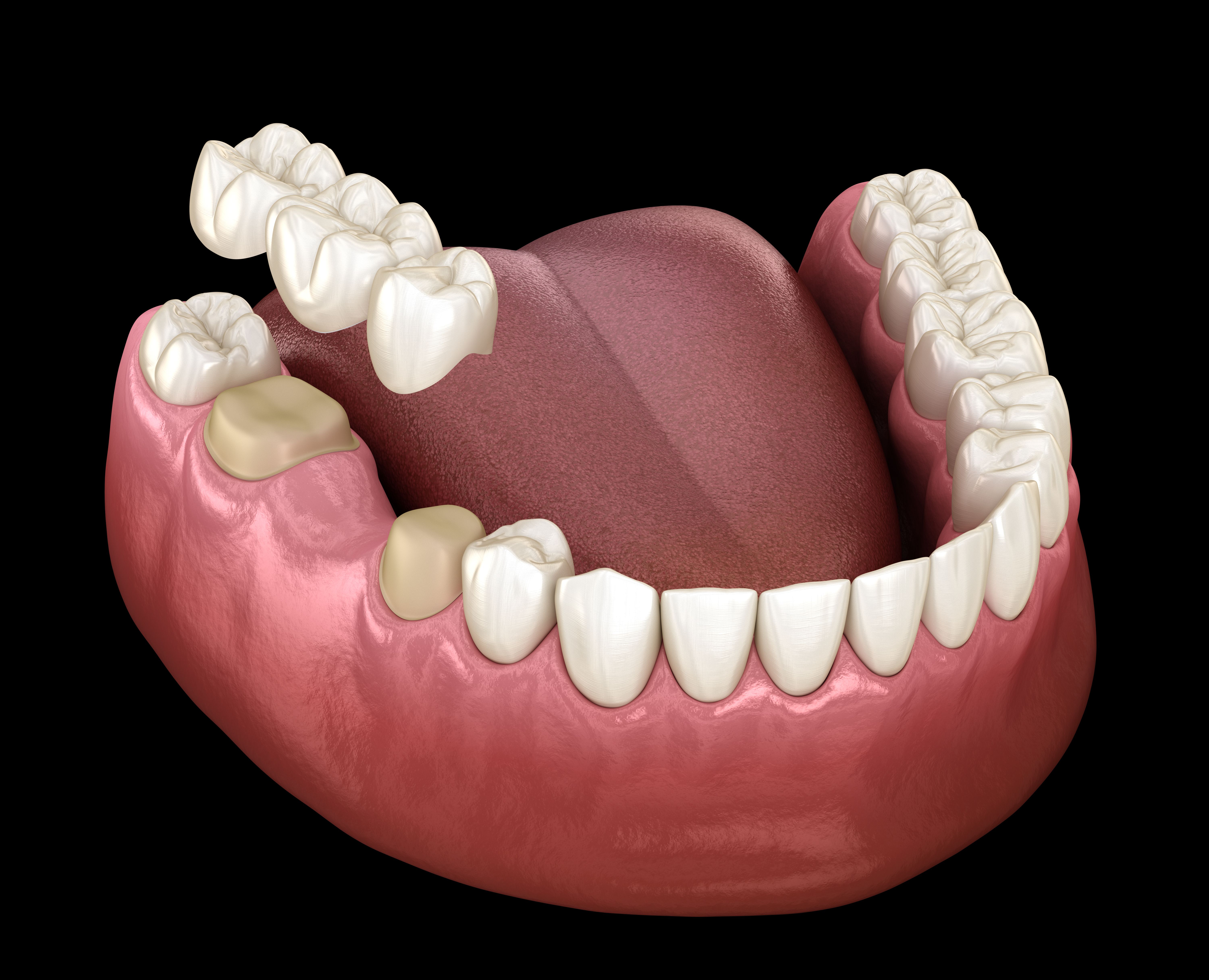 Dental illustration of a lower jaw with two teeth prepared for a three-unit bridge, shown hovering above the gap.