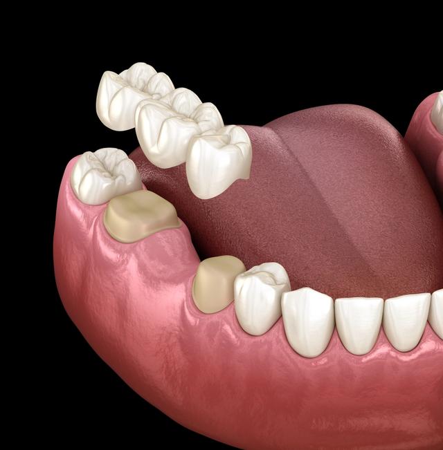 Dental illustration of a lower jaw with two teeth prepared for a three-unit bridge, shown hovering above the gap.