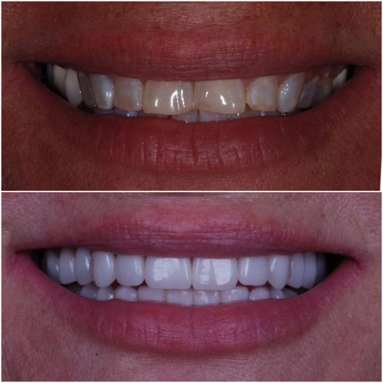 Before and after close-up of a smile, showing yellowed, uneven teeth transformed into bright white, perfectly aligned teeth.