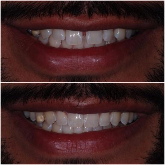 A smile before (top) and after (bottom) dental work, showing corrected alignment, closed gaps, and whiter teeth.
