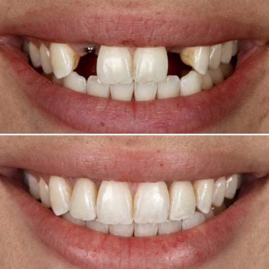 a before and after picture of a woman 's teeth .