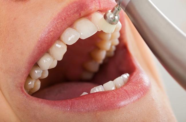 a woman is getting her teeth cleaned by a dentist .