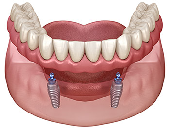 3D illustration of a jaw with a full upper set of teeth and a lower denture secured by two dental implants.