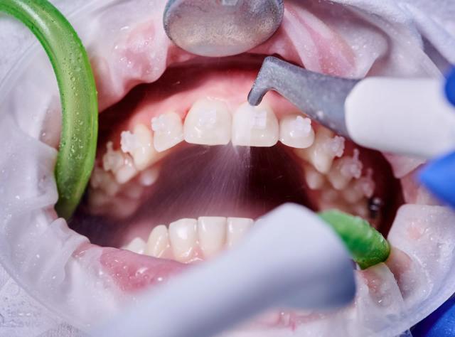 a close up of a person 's teeth being cleaned by a dentist .