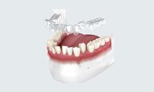 a 3d model of a person 's teeth with braces on them .