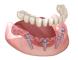 a computer generated image of a full denture with dental implants .