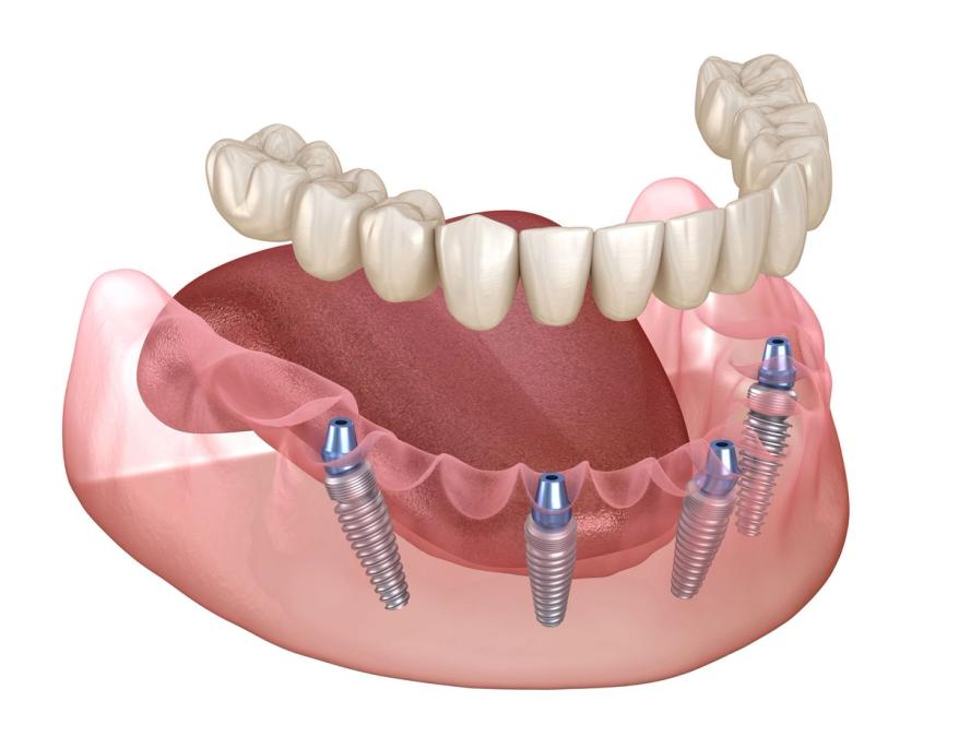 a computer generated image of a full denture with dental implants .