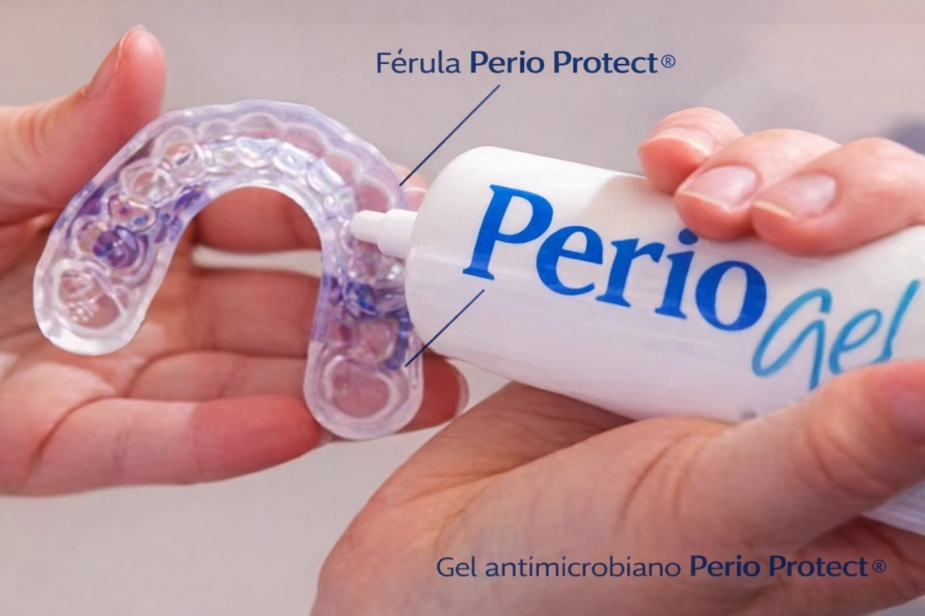 Hands applying PerioGel antimicrobial gel into a clear Perio Protect dental tray.