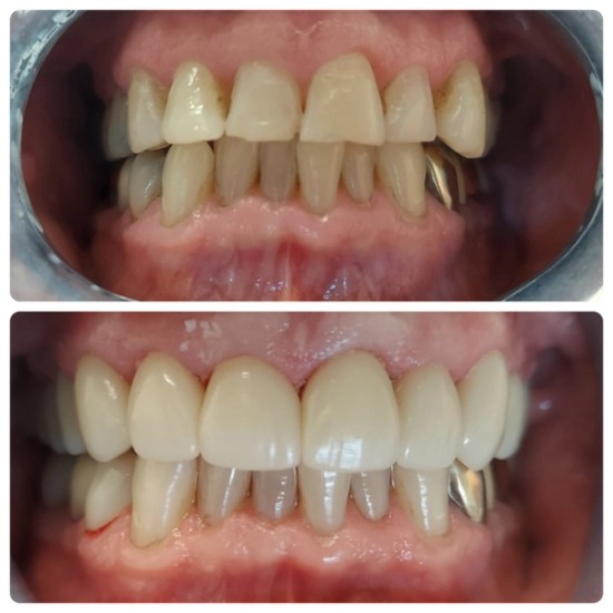a before and after picture of a person 's teeth