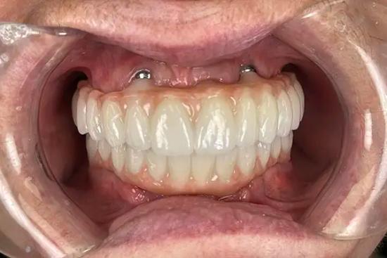 a close up of a person 's mouth with a full denture .