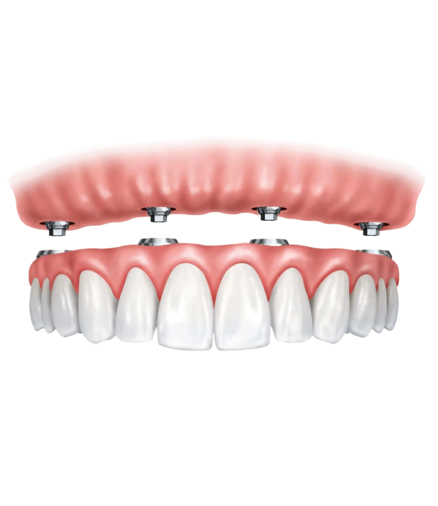 A lower jaw implant-supported denture system showing four abutments and the detached pink denture base.