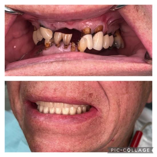 a before and after picture of a person 's teeth