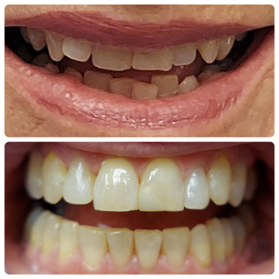 a before and after picture of a person 's teeth