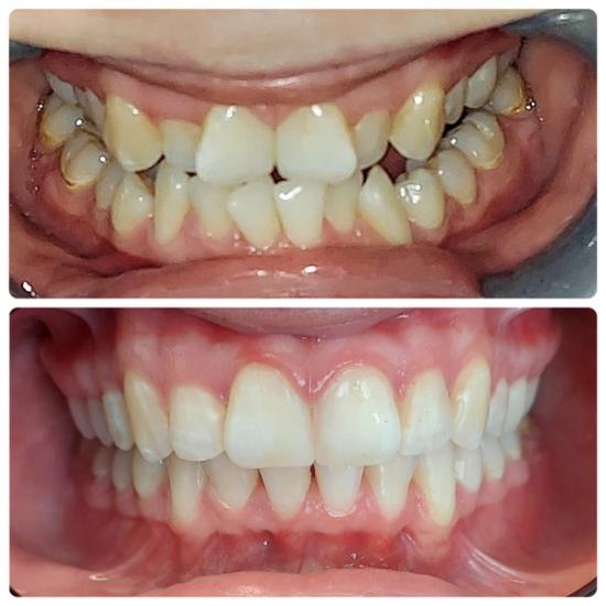 a before and after picture of a person 's teeth .