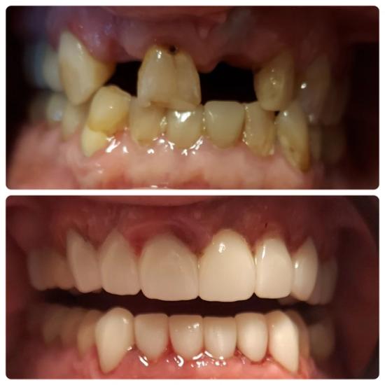a before and after photo of a person 's teeth .