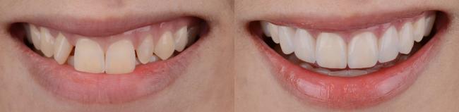 a before and after picture of a woman 's teeth .